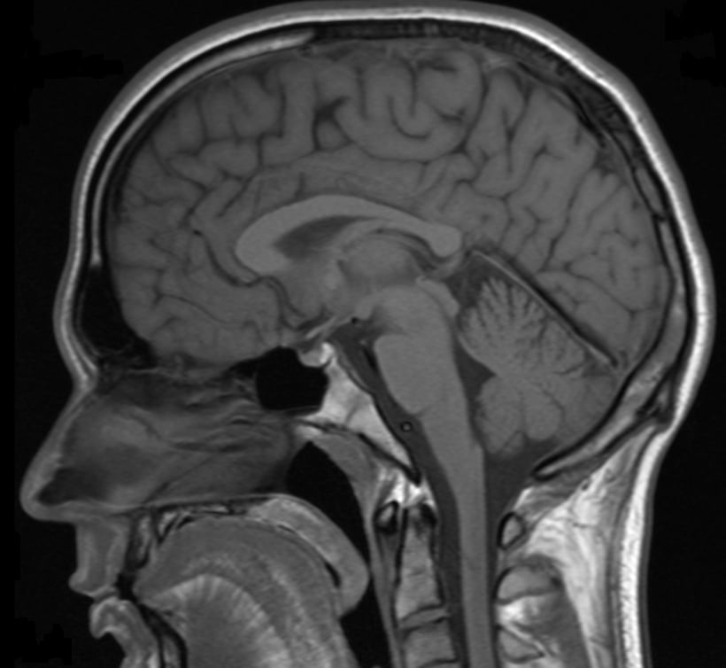 Chronic Traumatic Encephalopathy