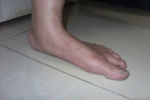 over-pronation of the foot