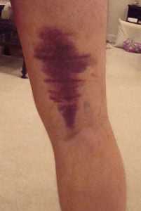 igns and Symptoms of Hamstring Strains